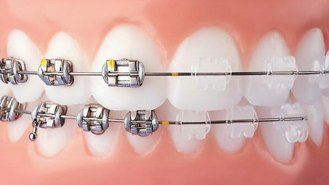 Dental Braces cost in India